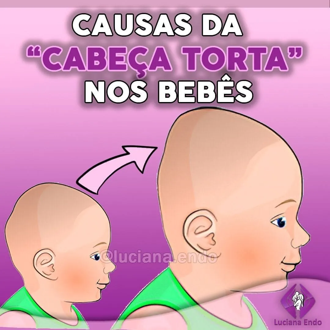 Entenda o que é a plagiocefalia (cabeça torta nos bebês) e quais as causas