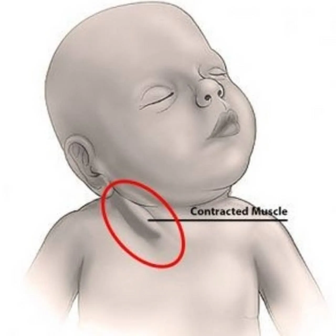 Torcicolo em bebês: entenda os sinais de uma forma simples